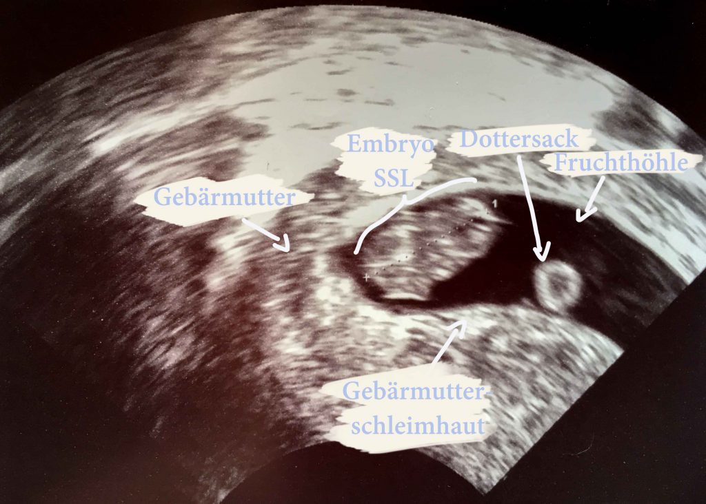 MamiWiki Schwangerschaft Ultraschall Sonografie Gebärmutter Sono Frühschwangerschaft Untersuchung Embryo Dottersack Fruchthöhle SSL Scheitel-Steißlänge SSW 8+0