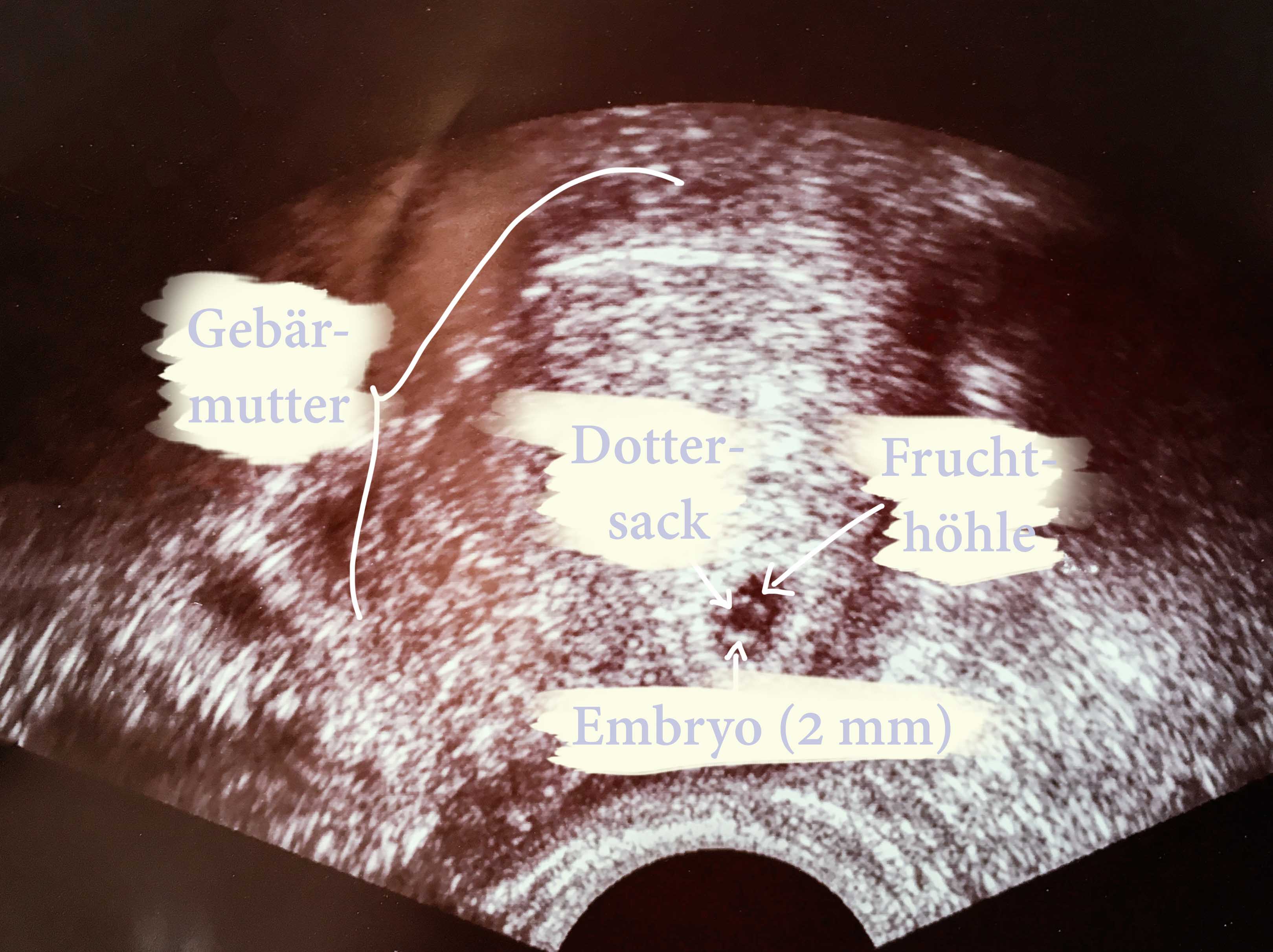 MamiWiki Schwangerschaft Ultraschall Sonografie Gebärmutter Sono Frühschwangerschaft Untersuchung Embryo Dottersack Fruchthöhle SSL Scheitel-Steißlänge SSW 5+0 Siegelring